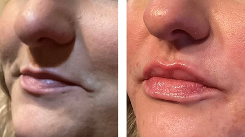 Dermal Filler Ashland KY - Before & After Lower Face and Lip Treatment